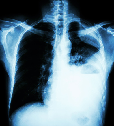 Fibrosi polmonare idiopatica, un nuovo farmaco sembra promettente. I risultati dello studio sul Nejm